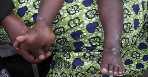 Cases of new mpox strain more than double among children in DR Congo and Burundi  | Africanews